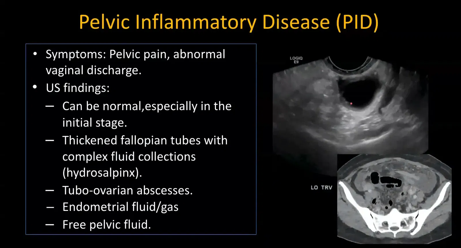 Dilated fallopian tube with thickened walls indicating hydrosalpinx