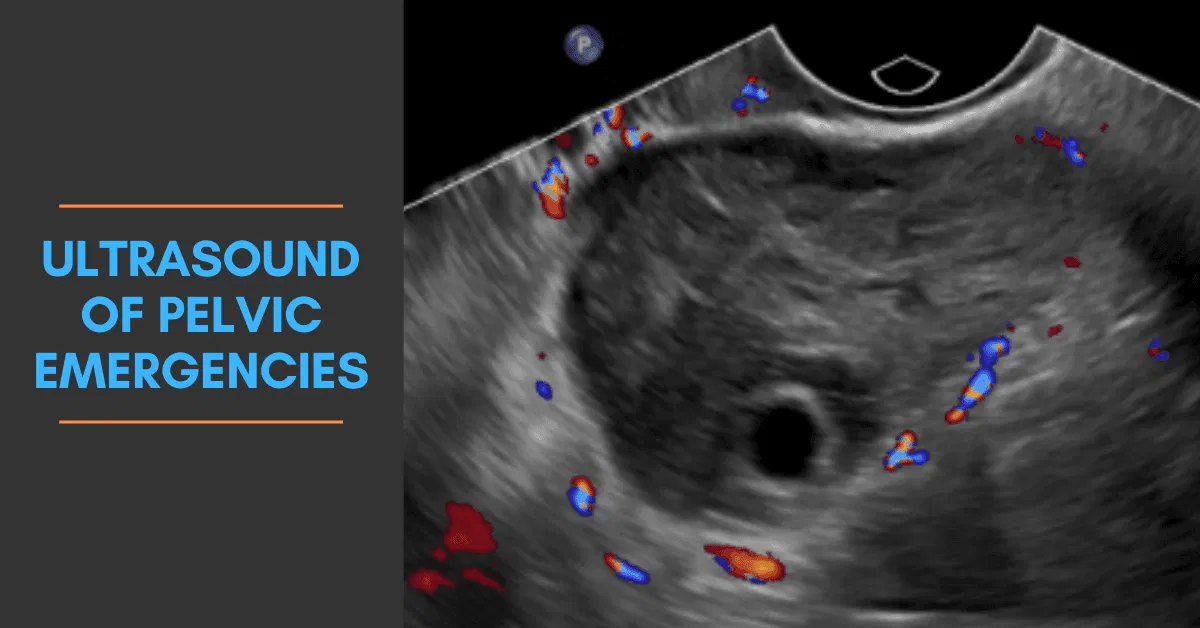 Color Doppler ultrasound shows a gestational sac with increased peripheral vascularity.