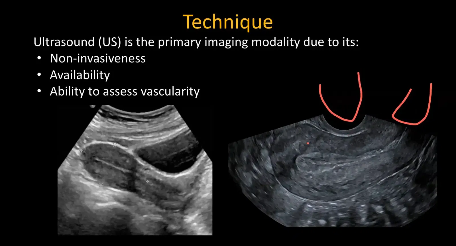 Transvaginal ultrasound orientation showing uterus and adnexa
