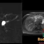 MCRP and axial T2 weighted MRI showing dilated intrahepatic ducts with a beaded morphology in a patient with primary sclerosing cholangitis.