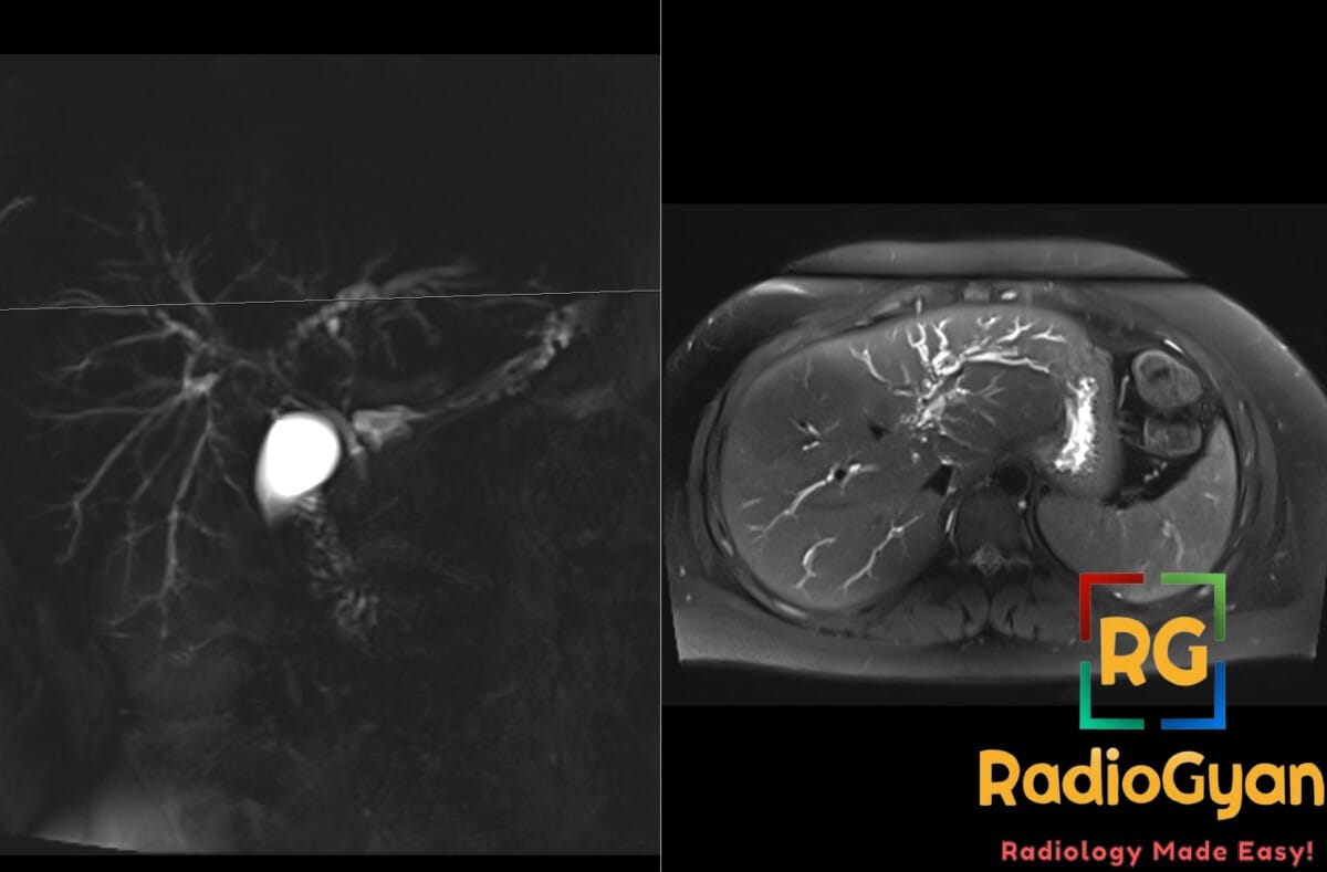 MCRP and axial T2 weighted MRI showing dilated intrahepatic ducts with a beaded morphology in a patient with primary sclerosing cholangitis.