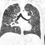 Coronal CT image shows diffuse nodular opacities within both lungs in a patient with miliary tuberculosis.