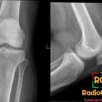 Anteroposterior and lateral radiographs of the knee joint showing soft tissue thickening anteriorly in a patient with prepatellar bursitis housemaid knee