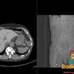 CT scan showing hyperdense liver in a patient on Amiodarone, indicating drug-induced toxicity effects.