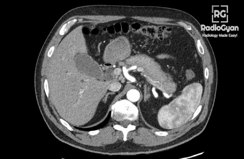 Axial CT Scan: Autoimmune IgG4-Related Pancreatitis Axial CT scan showing diffuse sausage-shaped enlargement of the pancreas in autoimmune IgG4-related pancreatitis.