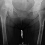 AP pelvis X-ray showing an atypical femur fracture on the left side, suggestive of bisphosphonate-related injury.