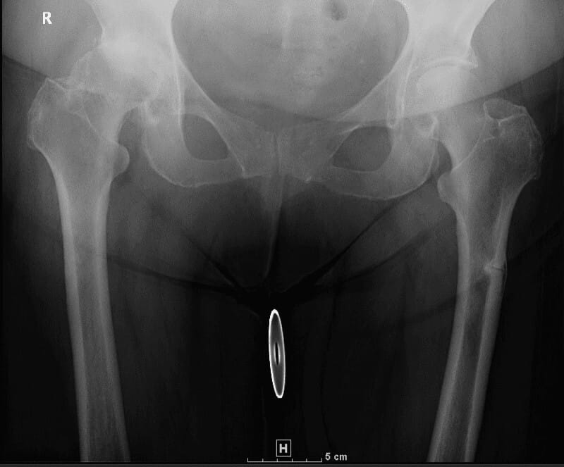 AP pelvis X-ray showing an atypical femur fracture on the left side, suggestive of bisphosphonate-related injury.