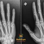 AP and oblique X-ray views of the right hand. Boxer's fracture of the fifth metacarpal neck is visible.