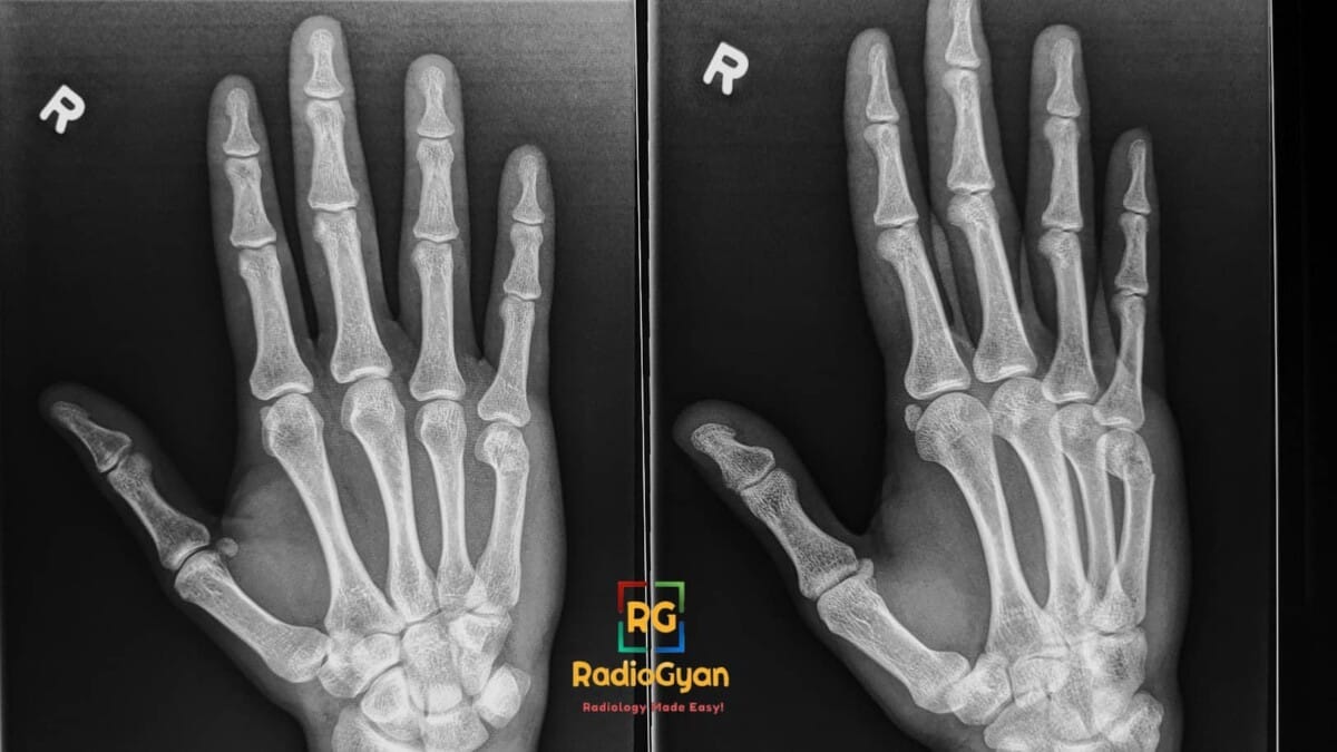 AP and oblique X-ray views of the right hand. Boxer's fracture of the fifth metacarpal neck is visible.