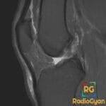 Sagittal MRI of the knee showing normal anatomy, fluid in the knee joint and patellar tendon.