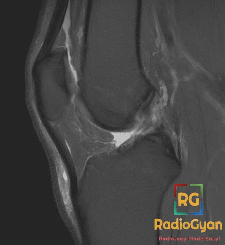 Sagittal MRI of the knee showing normal anatomy, fluid in the knee joint and patellar tendon.