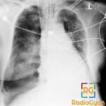 Chest X-ray showing deep sulcus sign in the left hemithorax, indicative of pneumothorax.