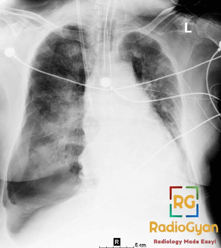 Chest X-ray showing deep sulcus sign in the left hemithorax, indicative of pneumothorax.