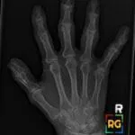 X-ray of the right hand showing erosive changes in the interphalangeal joints and polydactyly of the thumb.