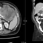 Axial and coronal CT of the abdomen showing a large gastrointestinal stromal tumor (GIST).