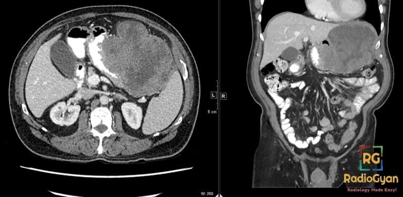 Axial and coronal CT of the abdomen showing a large gastrointestinal stromal tumor (GIST).