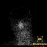 Nuclear medicine scan showing increased radiotracer uptake in the nasopharynx, consistent with the hot nose sign.