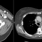 CT scans showing axial views of the neck and chest, essential for diagnosing left recurrent laryngeal nerve palsy.