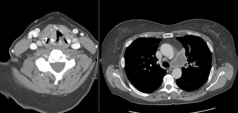 CT scans showing axial views of the neck and chest, essential for diagnosing left recurrent laryngeal nerve palsy.
