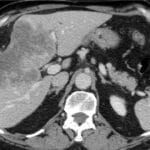 Axial CT scan of the abdomen showing a mass-forming cholangiocarcinoma in the liver.