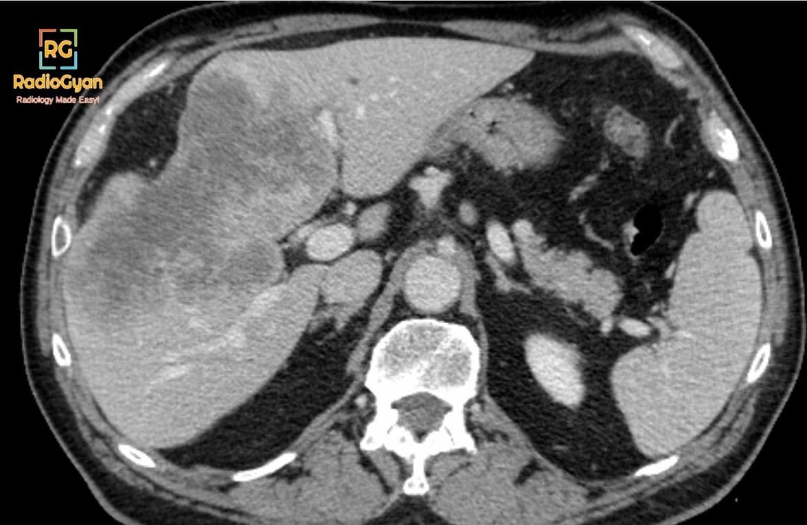 Axial CT scan of the abdomen showing a mass-forming cholangiocarcinoma in the liver.