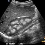 Ultrasound image of a right kidney showing marked echogenicity of the medullary pyramids, indicative of medullary nephrocalcinosis.