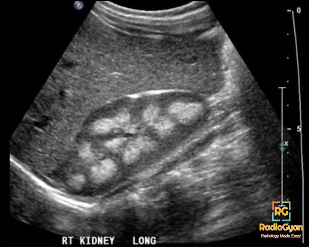 Ultrasound image of a right kidney showing marked echogenicity of the medullary pyramids, indicative of medullary nephrocalcinosis.