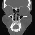 Coronal CT scan showing a nasal septum perforation and clear paranasal sinuses.