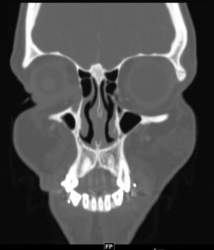 Coronal CT scan showing a nasal septum perforation and clear paranasal sinuses.