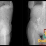 Lateral and AP X-rays of the abdomen showing a neurostimulator in the gluteal region with its tip in the lower thoracic spinal canal.