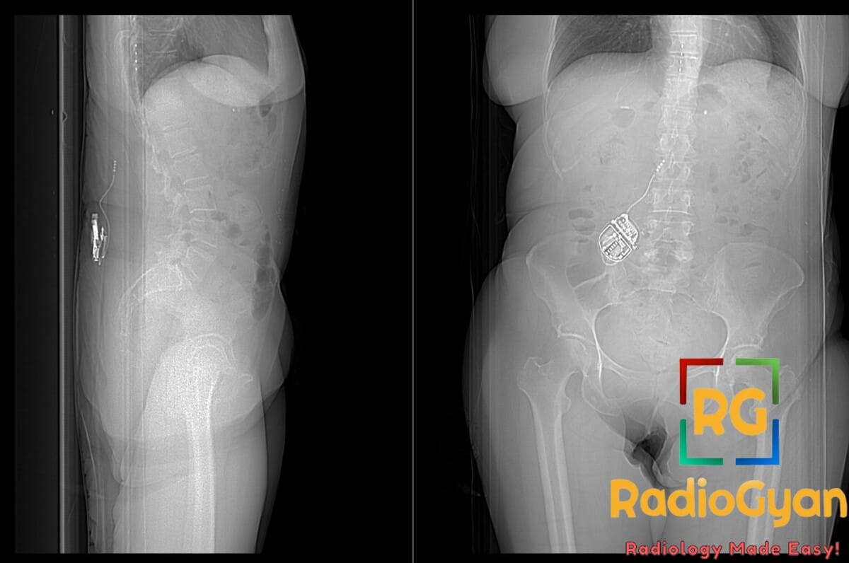 Lateral and AP X-rays of the abdomen showing a neurostimulator in the gluteal region with its tip in the lower thoracic spinal canal.