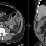 CT abdomen showing diffuse concentric thickening of the right colon, consistent with neutropenic colitis.