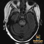Axial FLAIR MRI showing hyperintensity in the central pontine region, indicative of osmotic demyelination syndrome.
