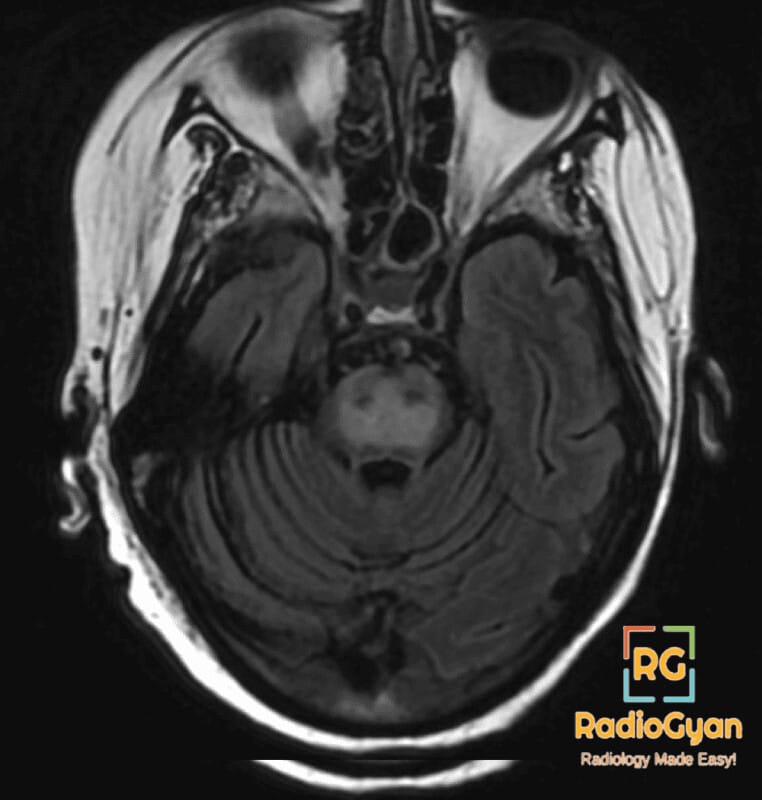 Axial FLAIR MRI showing hyperintensity in the central pontine region, indicative of osmotic demyelination syndrome.
