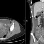 CT scan showing markedly enlarged ovaries with multiple cysts in ovarian hyperstimulation syndrome (OHSS).