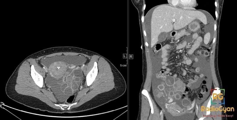 CT scan showing markedly enlarged ovaries with multiple cysts in ovarian hyperstimulation syndrome (OHSS).