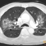 CT scan of the chest showing bilateral pulmonary infiltrates consistent with PCP pneumonia.