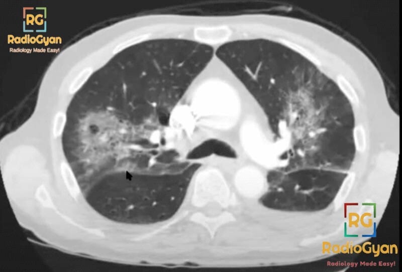 CT scan of the chest showing bilateral pulmonary infiltrates consistent with PCP pneumonia.