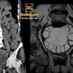 Coronal CT and sagittal MRI images showing a large pelvic cystic mass with daughter cysts consistent with hydatid disease.