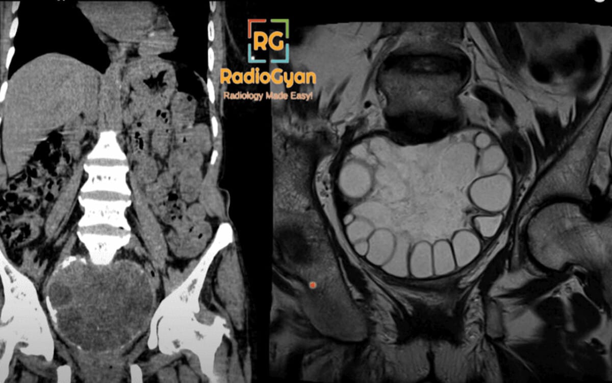Coronal CT and sagittal MRI images showing a large pelvic cystic mass with daughter cysts consistent with hydatid disease.