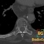 Axial CT image showing a vertebral hemangioma with a classic polka-dot appearance in the spine.