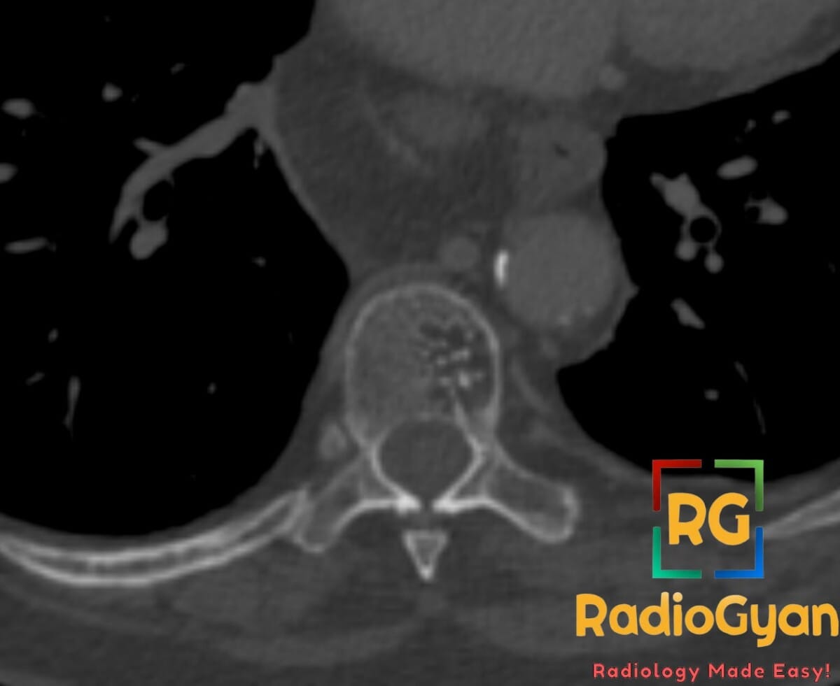 Axial CT image showing a vertebral hemangioma with a classic polka-dot appearance in the spine.