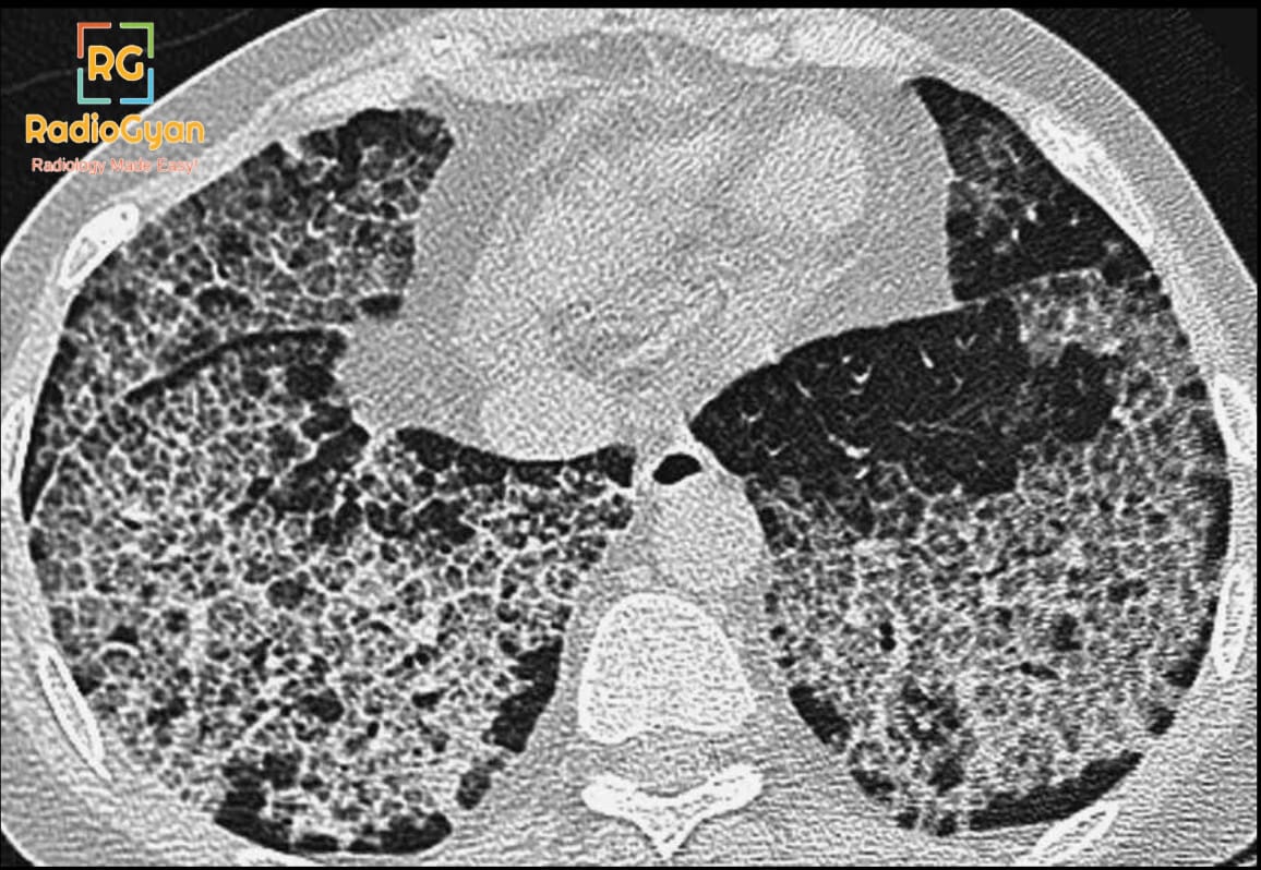 CT scan of lungs showing crazy paving pattern indicative of pulmonary alveolar proteinosis.