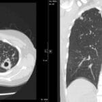 CT thorax showing cavitary lesion in left upper lobe and diffuse centrilobular nodules indicative of pulmonary tuberculosis.