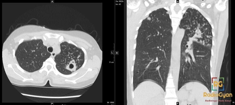 CT thorax showing cavitary lesion in left upper lobe and diffuse centrilobular nodules indicative of pulmonary tuberculosis.