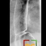 Esophagogram showing Schatzki B-ring and hiatal hernia in a barium swallow study.
