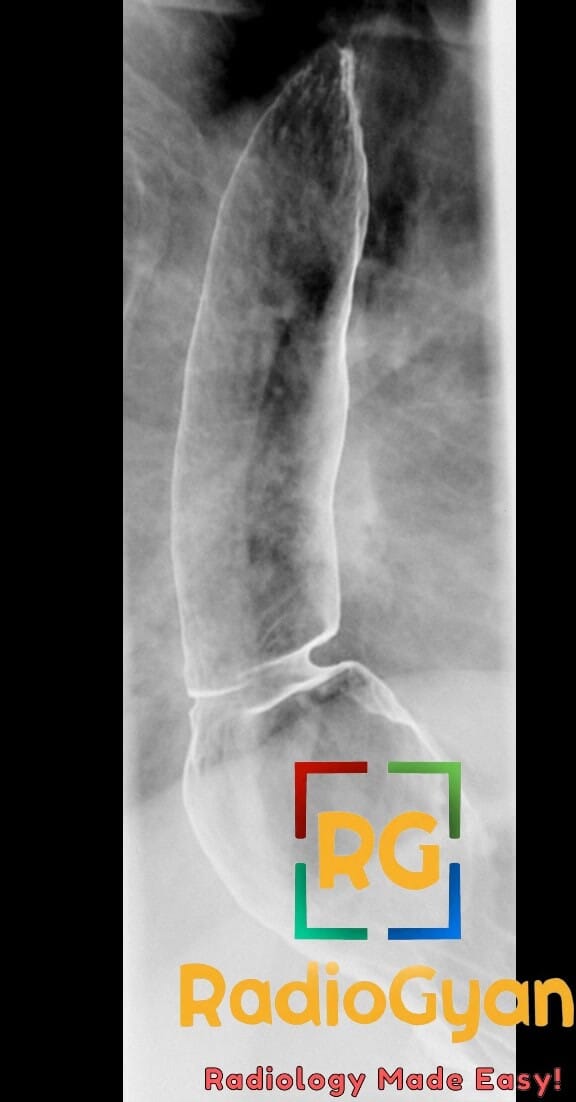Esophagogram showing Schatzki B-ring and hiatal hernia in a barium swallow study.