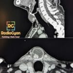 Sagittal and axial CT images showing a thyroglossal duct cyst with suspicious findings suggestive of carcinoma.