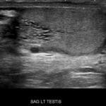 Ultrasound image showing tubular ectasia of rete testis in the left testis with a prominent anechoic area and dilated tubules.