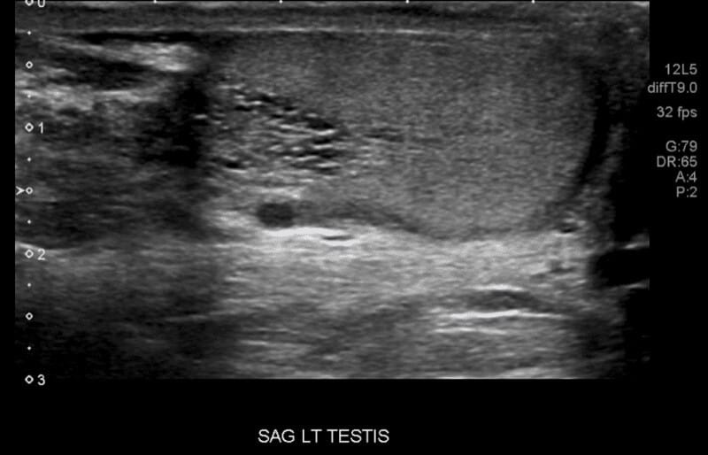Ultrasound image showing tubular ectasia of rete testis in the left testis with a prominent anechoic area and dilated tubules.